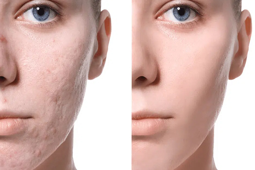 Acne Scar Removal