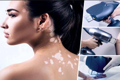 Vitiligo Treatment white patches on skin remove by laser