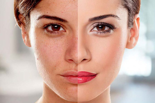 skin whitening result after treatment and before glow